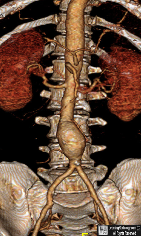 Abdominal Aortic Aneurysm